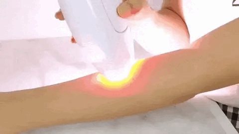 Depilador Láser IPL Profesional